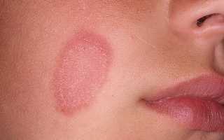 Кандидоз кожи