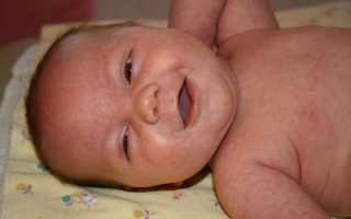 Что делать если появилась молочница на языке у новорожденного