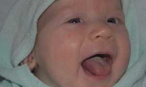 Детская молочница: формы, симптомы и лечение