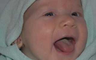 Детская молочница: формы, симптомы и лечение