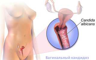 Молочница — симптомы, причины, лечение
