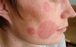 Кандидоз кожи лица