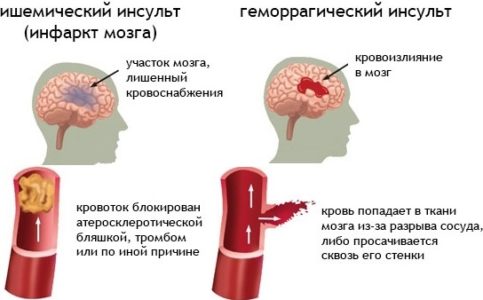 Формы инсульта