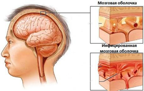 Классификация менингита у взрослых