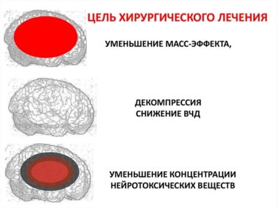 Лечение отечности головного мозга хирургическим методом