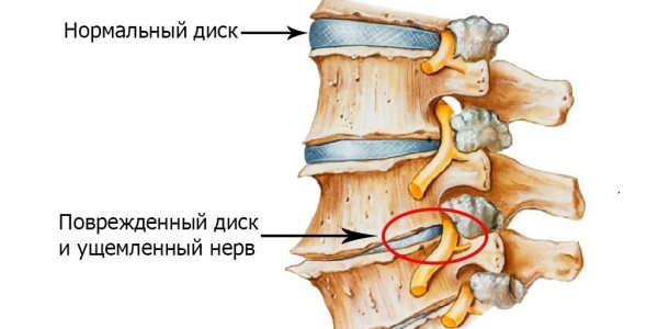 Причины головокружения при остеохондрозе