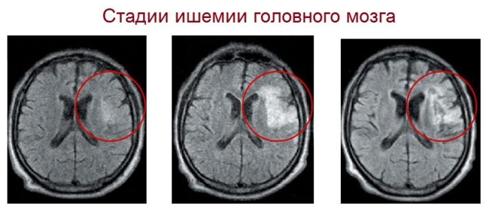 Стадии ишемии головного мозга