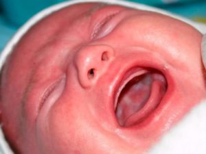 Молочница у новорожденного