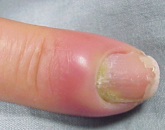 Воспаление ногтевого валика