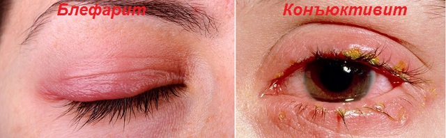 Болезни глаз