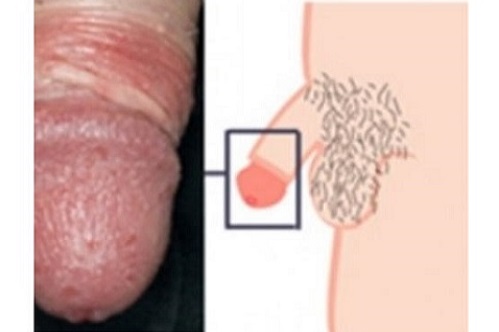Покраснение головки члена при молочнице