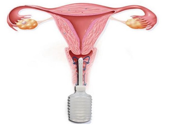 Спринцевание влагалища