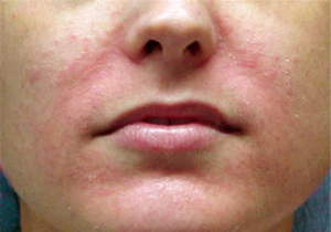 Кандидоз гладкой кожи