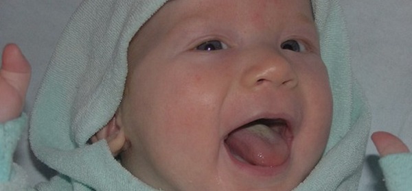 Ребенок с молочницей