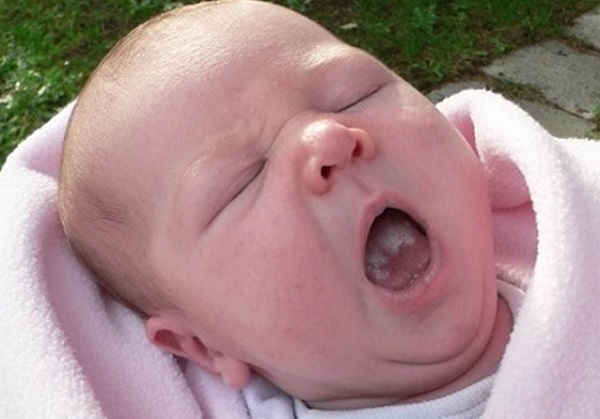 Молочница во рту у ребенка