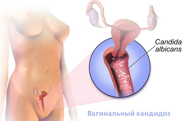 Вагинальный кандидоз