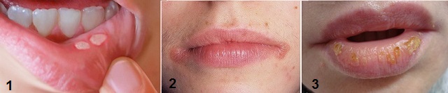 Молочница на губах