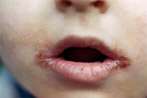 Заеды у ребенка