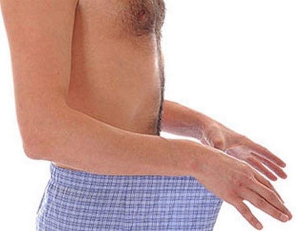 Молочница у мужчин