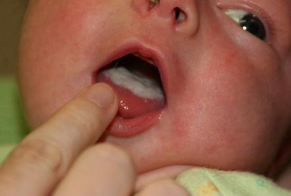 Налет на языке ребенка