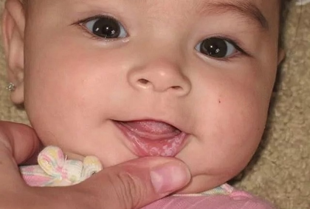 Белый налет во рту у ребенка