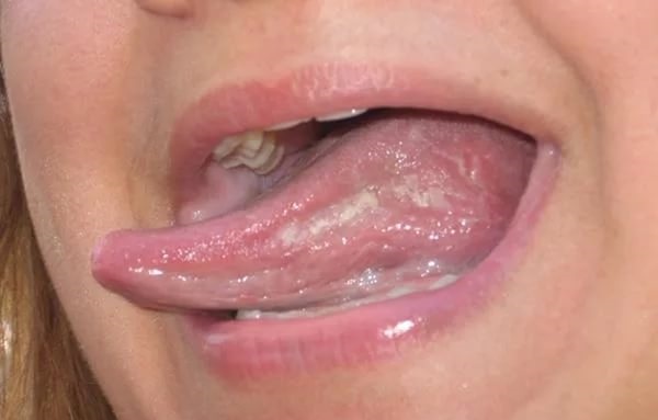 Белый налет на языке