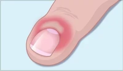 Покраснение ногтевого валика