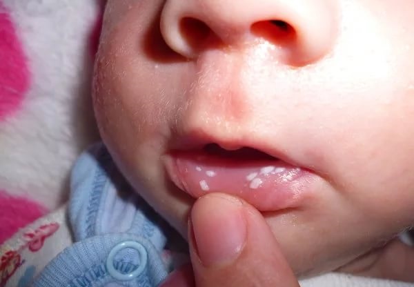 Молочница во рту у ребенка