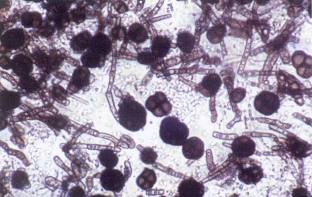 Грибок Кандида под микроскопом