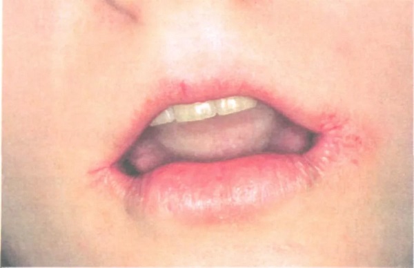 Потрескавшиеся губы