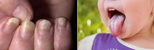 Поверхностная молочница