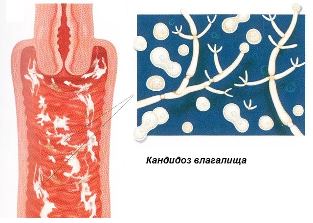 Кандидоз влагалицща