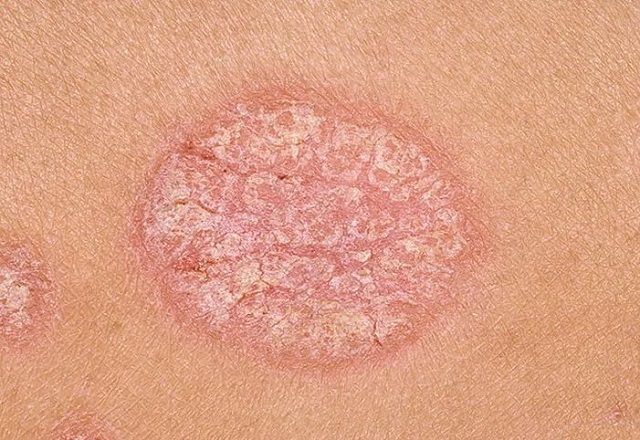 Кандидоз кожи