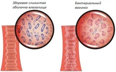 Бактериальный вагиноз