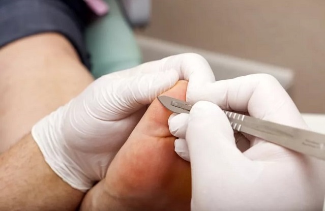 Соскоб кожи