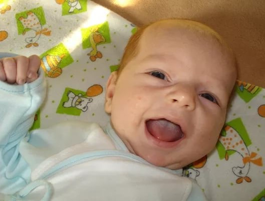 Новорожденный с молочницей на языке