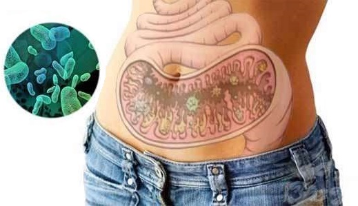 Дисбактериоз кишечника