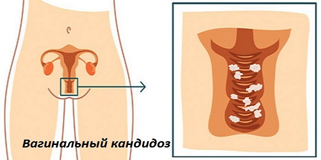 Вагинальный кандидоз