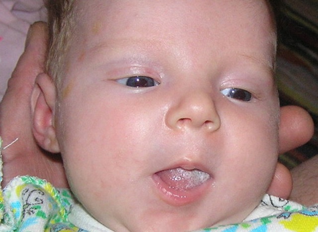 Налет во рту у новорожденного