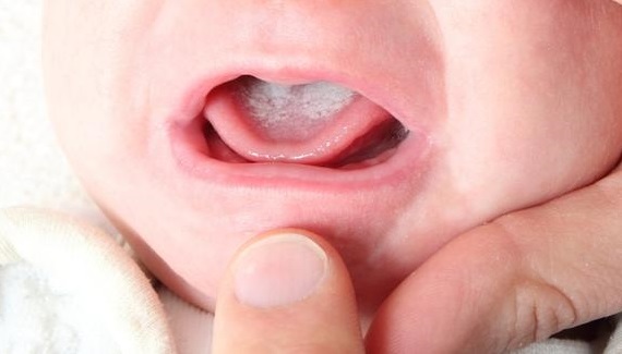 Налет во рту у ребенка