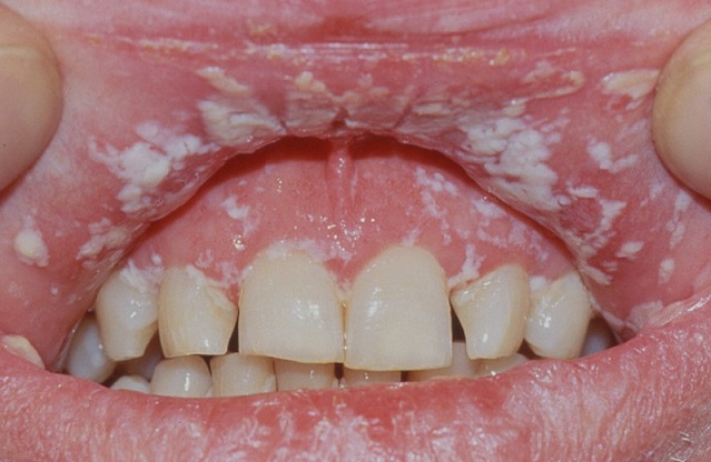 Молочница ротовой полости