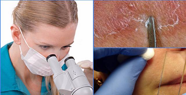 Соскоб кожи для анализа