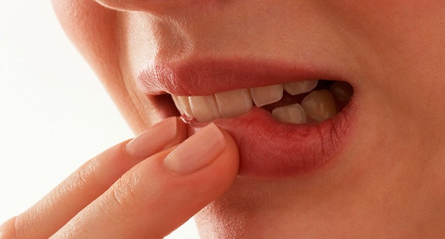 Кандидозный стоматит