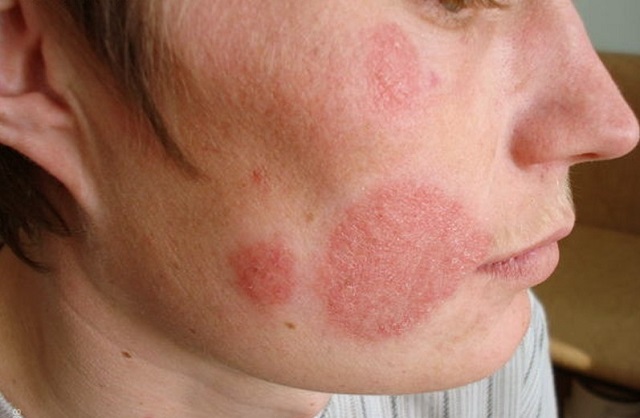 Кандидоз на коже лица