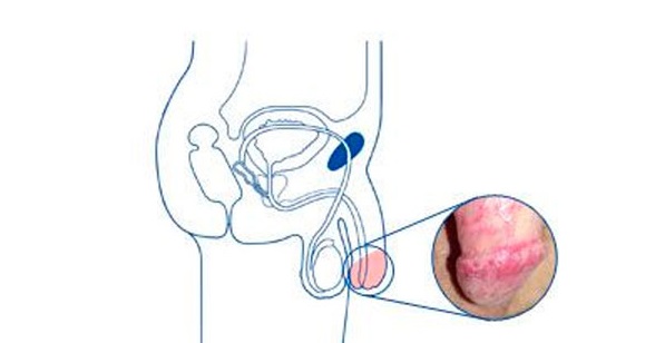 Краснота на пенисе
