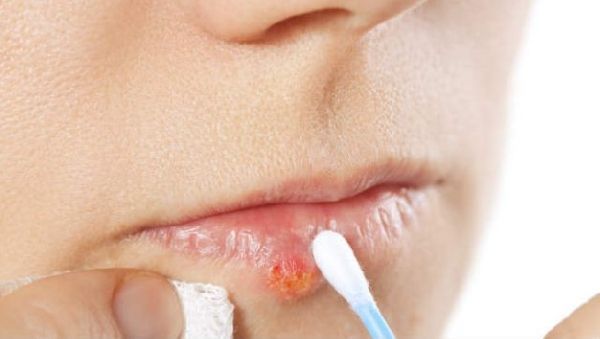 Обработка больной губы