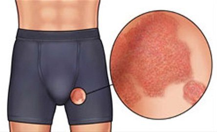 Молочница в паху у мужчины